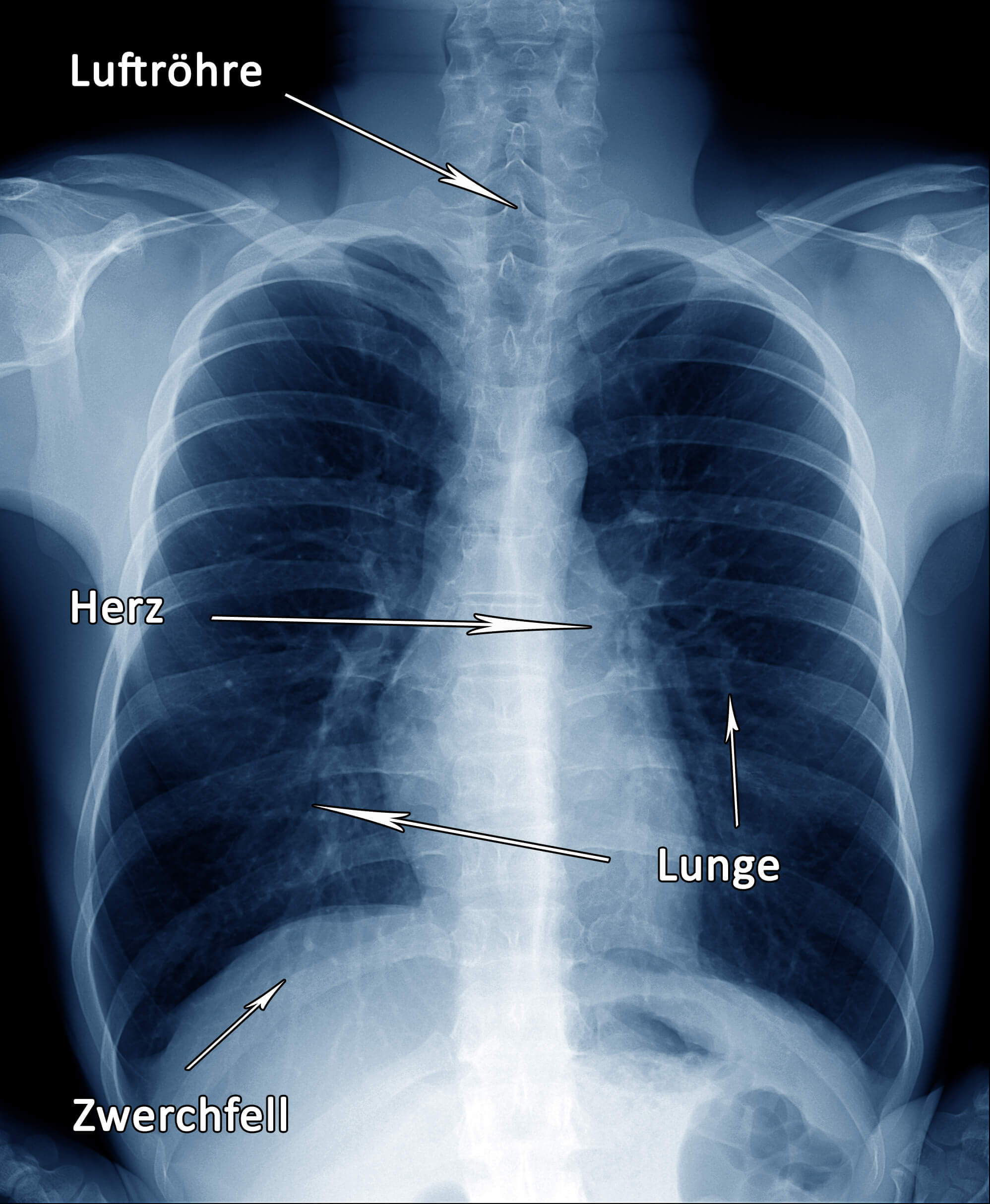 Röntgen Der Lunge Was Kann Man Sehen.
