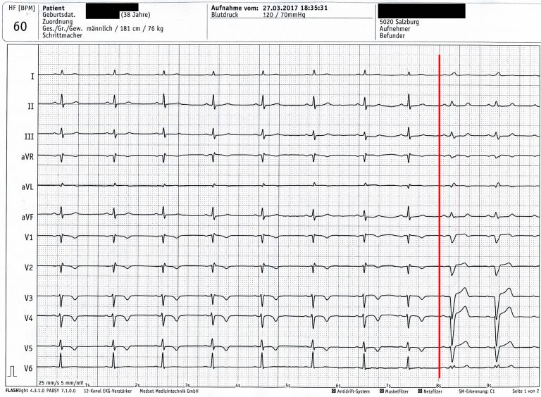 12 kanal ekg Anlegen So Funktioniert Es Richtig Ekg Richtig Anlegen 12 kanal ekg Anlegen So Funktioniert Es Richtig Ekg Richtig Anlegen