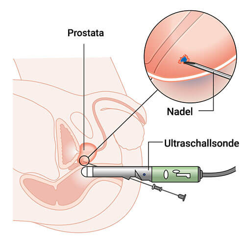 biopsie prostata)