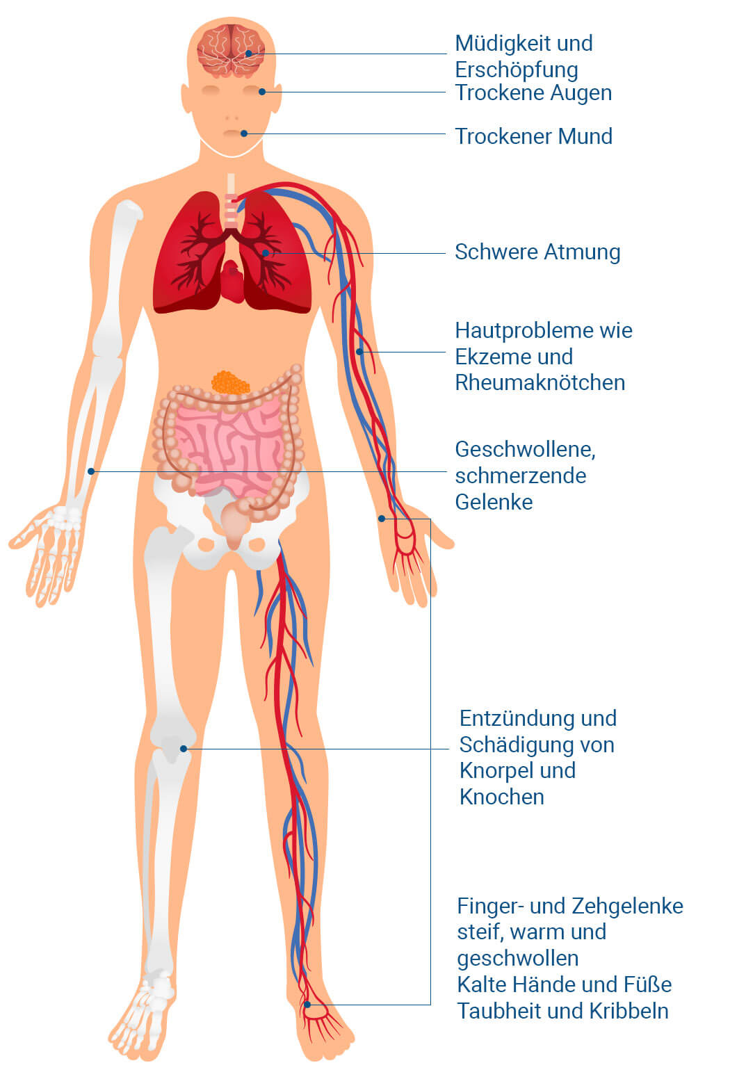 rheuma arthritis symptome