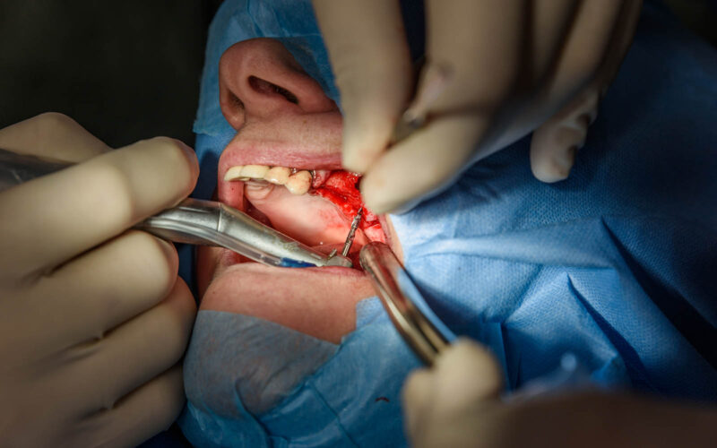 Eingriff Dentoalveolären Chirurgie