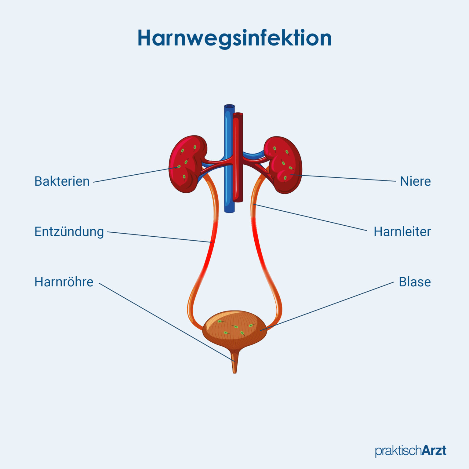 Harnwegsinfektion: Ursachen, Symptome, Therapie